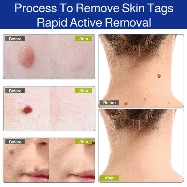 Patch Wart Flesh Mole Acne Patch Beauty Skin Care No Pain Easy To Operate🌟