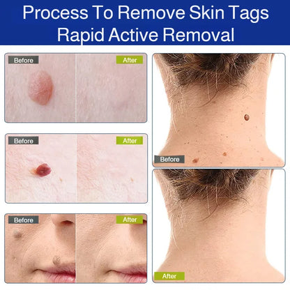 Patch Wart Flesh Mole Acne Patch Beauty Skin Care No Pain Easy To Operate🌟