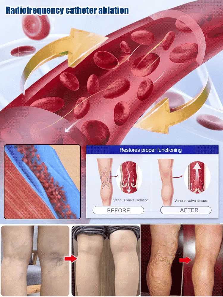 Leg Vein Treatment Spray🌱