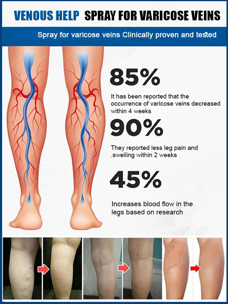 Leg Vein Treatment Spray🌱
