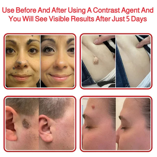 Patch Wart Flesh Mole Acne Patch Beauty Skin Care No Pain Easy To Operate🌟