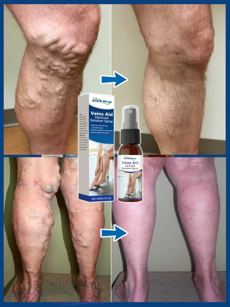 Leg Vein Treatment Spray🌱