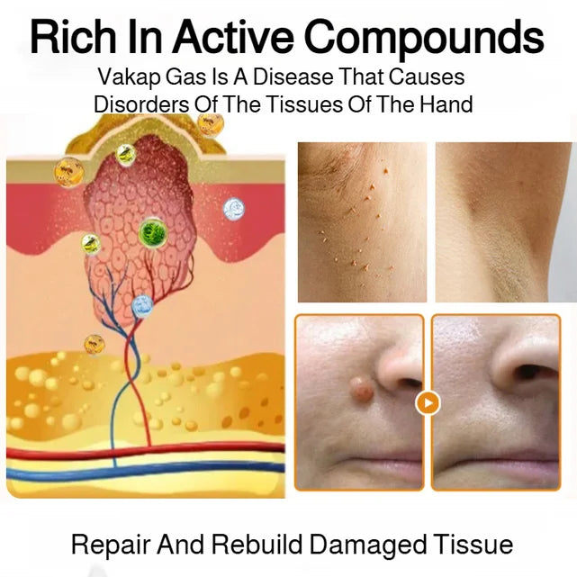 Patch Wart Flesh Mole Acne Patch Beauty Skin Care No Pain Easy To Operate🌟