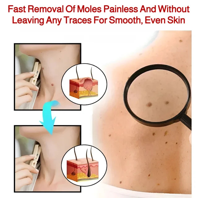 Patch Wart Flesh Mole Acne Patch Beauty Skin Care No Pain Easy To Operate🌟