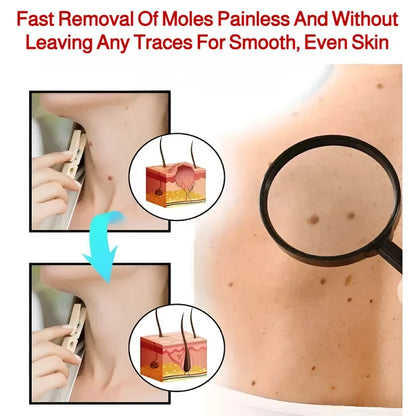 Patch Wart Flesh Mole Acne Patch Beauty Skin Care No Pain Easy To Operate🌟