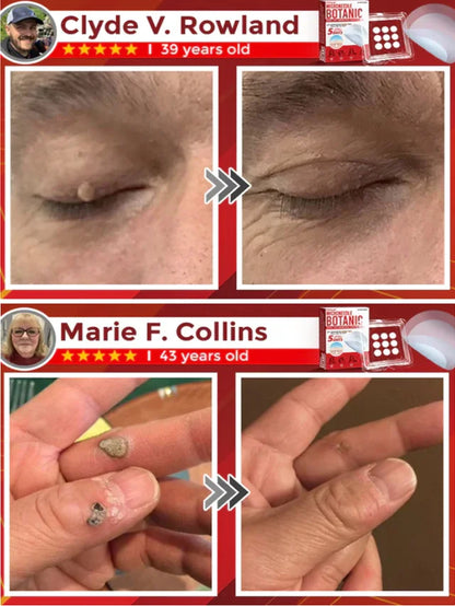 Plant Wart Microneedle Patch🌟