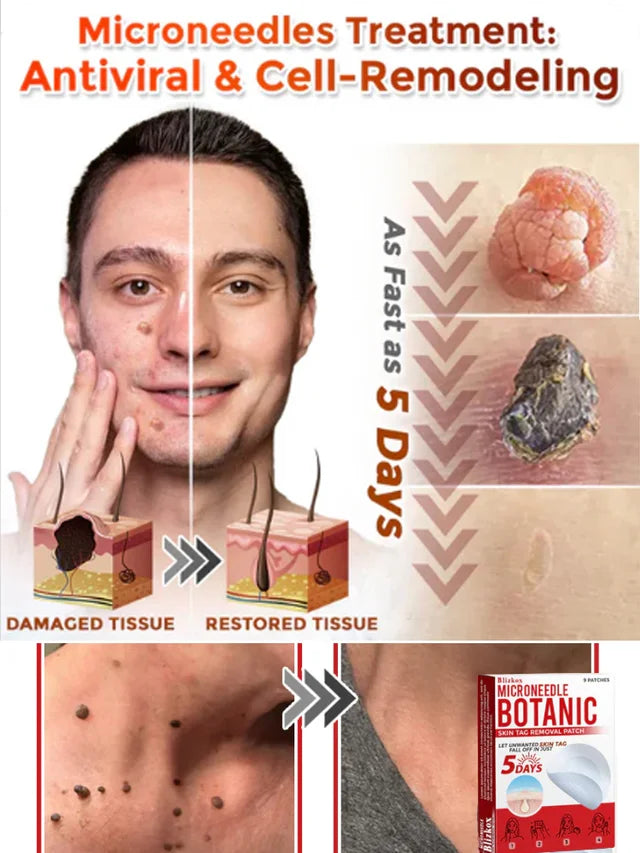 Plant Wart Microneedle Patch🌟