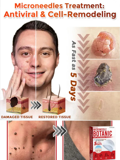 Plant Wart Microneedle Patch🌟