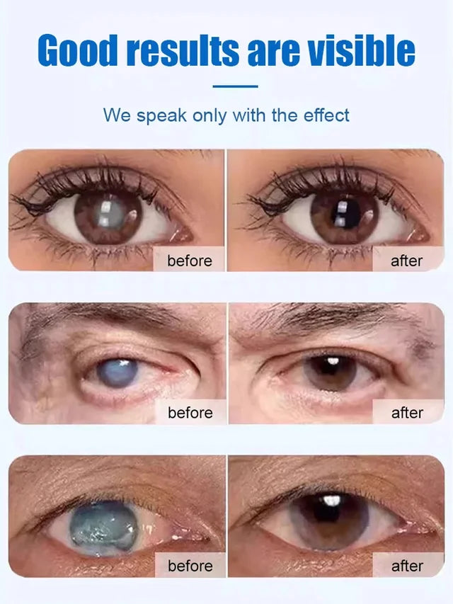 [Cataract Specialist] Eye Care Patch👁️💦