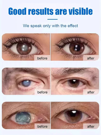 [Cataract Specialist] Eye Care Patch👁️💦