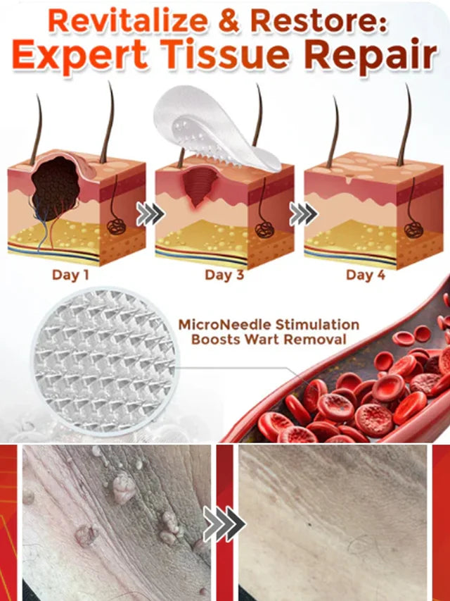 Plant Wart Microneedle Patch🌟