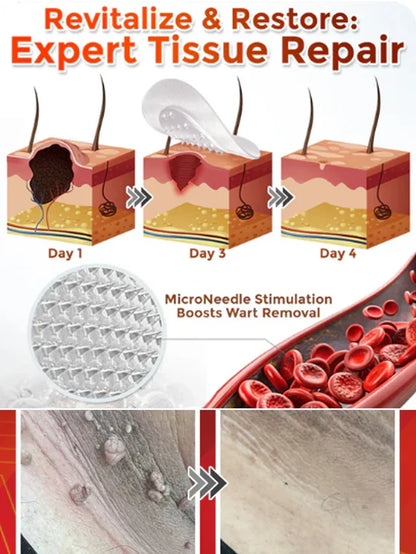 Plant Wart Microneedle Patch🌟