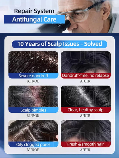 1% Ketoconazole Anti-Dandruff Shampoo💦💦