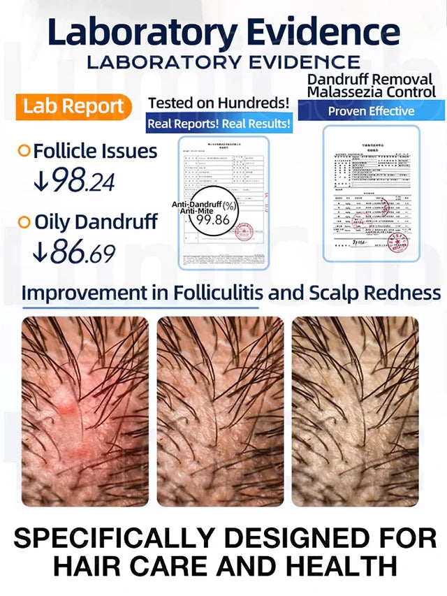 1% Ketoconazole Anti-Dandruff Shampoo💦💦