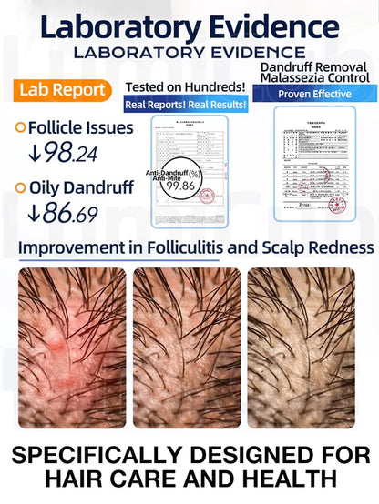 1% Ketoconazole Anti-Dandruff Shampoo💦💦