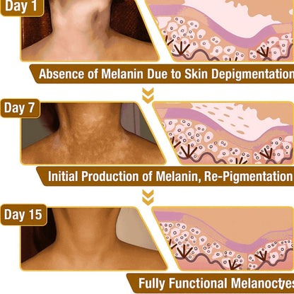 Vitiligo Removal Cream💦