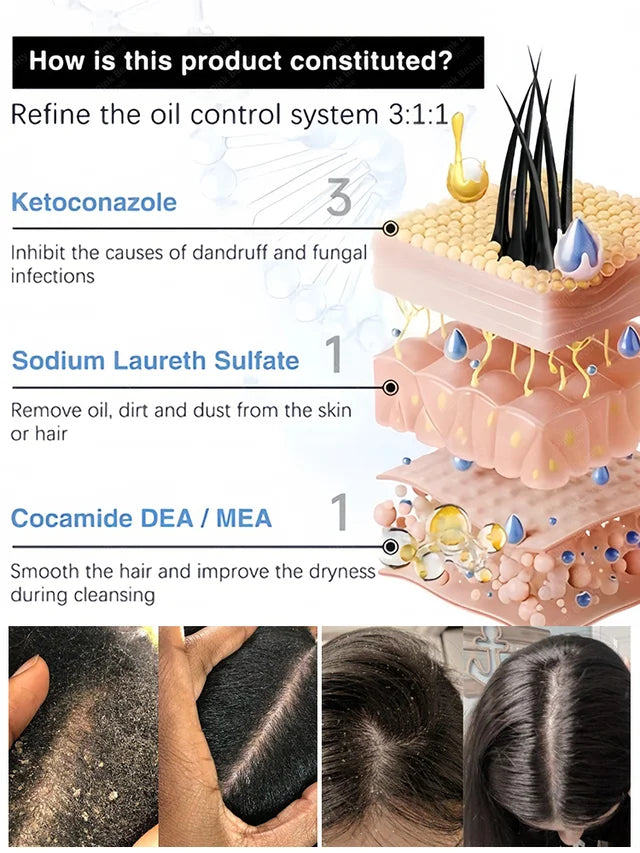 1% Ketoconazole Anti-Dandruff Shampoo💦💦