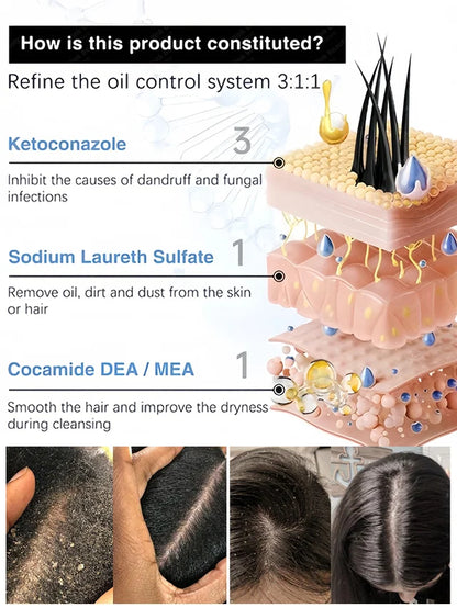 1% Ketoconazole Anti-Dandruff Shampoo💦💦