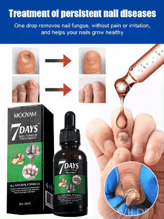 Ginger Nail Care Solution✨