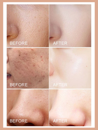 [Washes away 99.9% of dust mites] Salicylic acid soap🧼